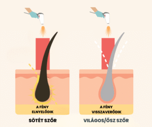 lezeres szortelenites osz szor eseten