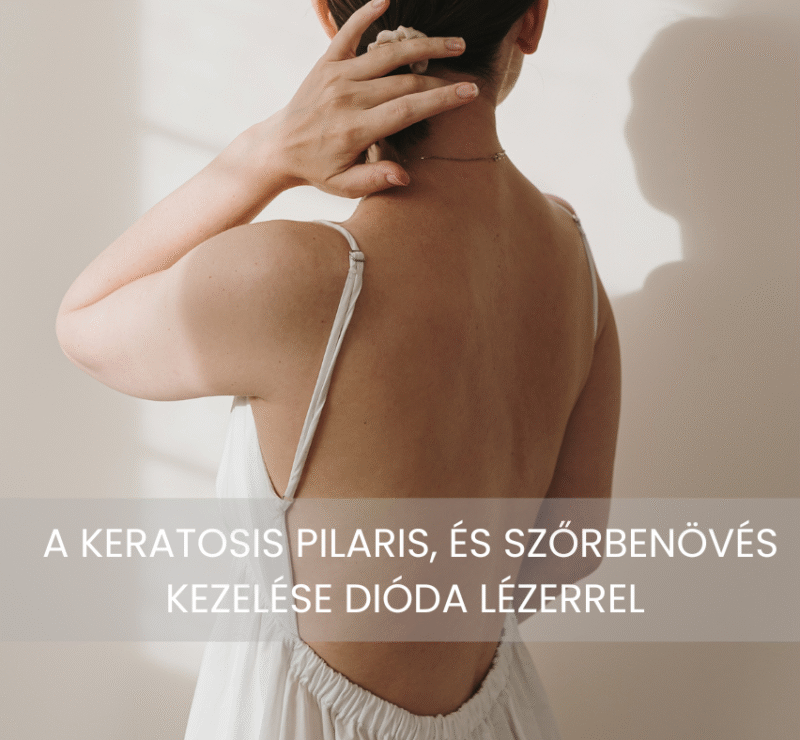 Keratosis pilaris kezelese dioda lezerrel van megoldas a csirkeborre es a szorbenovesre is 2